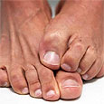 Лечение грибка ногтей на ногах, топ 5 эффективных препаратов