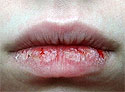 Трещины на губах - причины появления, методы лечения