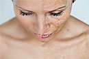 Борьба с пигментацией кожи путем проведения процедур с лазером